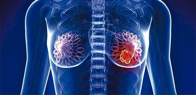 Mexicanos investigan molécula para conocer detalles de cáncer de mama