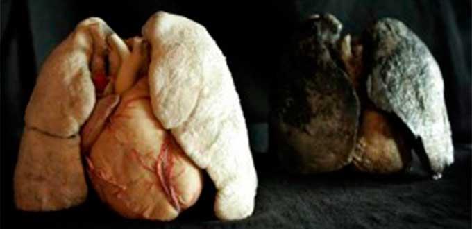 Cada año mueren en México casi ocho mil personas por cáncer de pulmón