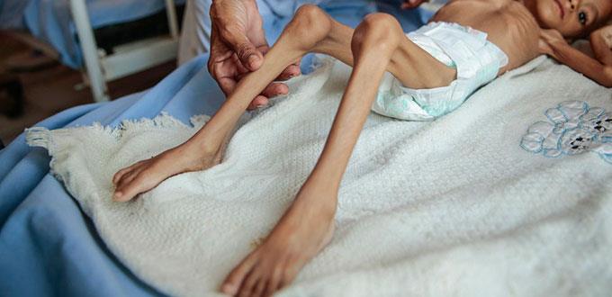 La vida de los niños en el Yemen se agota por la malnutrición