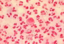 Investigan un brote de gonorrea multirresistente