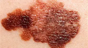 Anuncian resultados prometedores de vacuna contra melanoma 