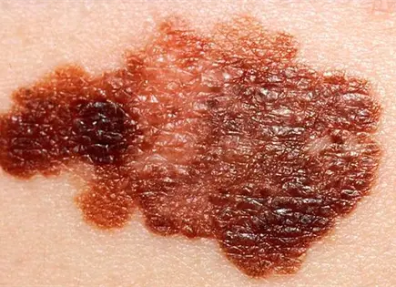 Anuncian resultados prometedores de vacuna contra melanoma Anuncian resultados prometedores de vacuna contra melanoma