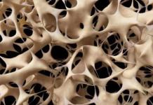Mil millones de personas sufrirán osteoartritis en 2050, según un estudio