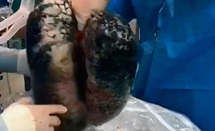 Rechazan donación de pulmones por presentar tejido muerto debido al cigarro