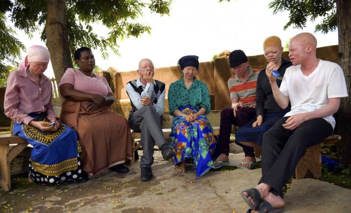 Albinos en África, víctimas de las supersticiones; los secuestran o matan porque se cree que tienen poderes especiales