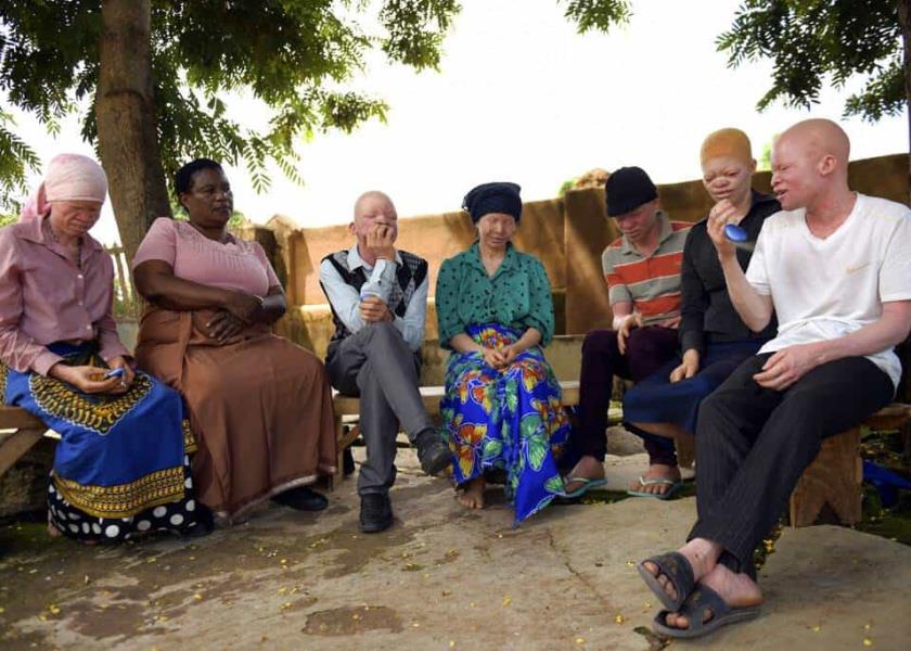 En África subsahariana los albinos sufren persecuciones / Foto: Archivo