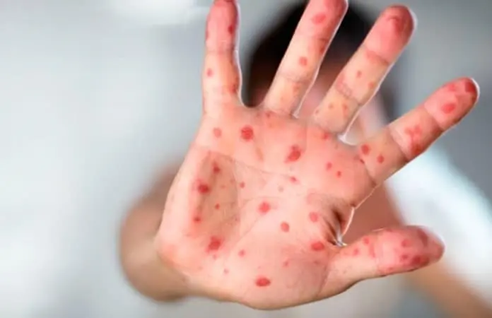 Sarampión más contagioso que Covid