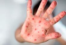 Alerta de salud: Niño diagnosticado con sarampión