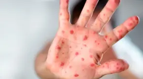 Sarampi&oacute;n: &iquest;Cu&aacute;les son los s&iacute;ntomas y c&oacute;mo prevenirlo?