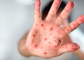 Brote de sarampión en México: síntomas y alerta sanitaria