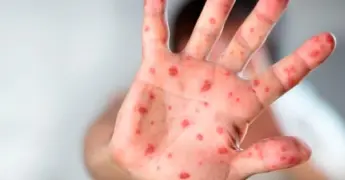 Brotes de sarampión en Estados Unidos llegan a su fin