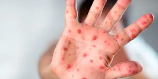 Brote de sarampión en México: síntomas y alerta sanitaria