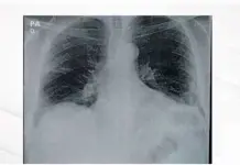 Evoluci&oacute;n de la capacidad pulmonar a lo largo de la vida