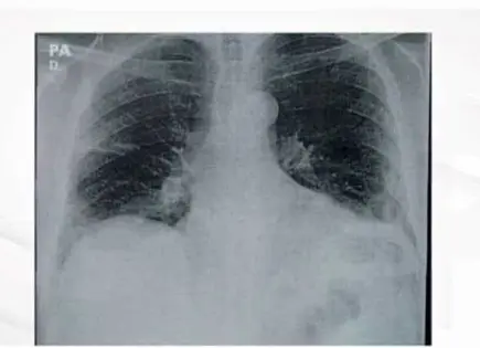 Evolución de la capacidad pulmonar a lo largo de la vida