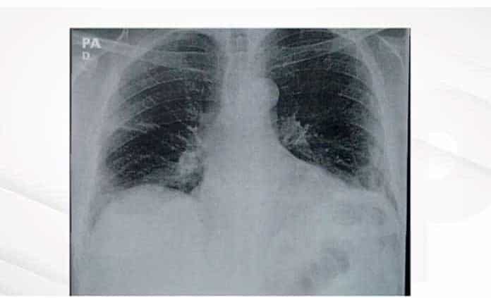 Evolución de la capacidad pulmonar a lo largo de la vida