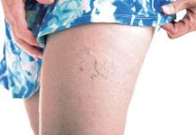 Várices: Mitos y realidades que debes conocer. Várices: Mitos y realidades que debes conocer.