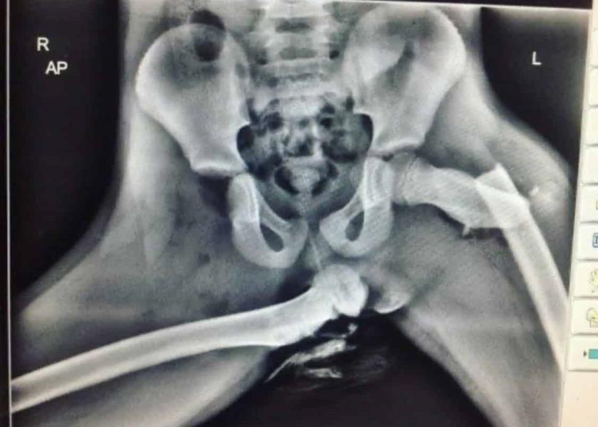 La radiografía de una persona  con daño severo en cadera y piernas, consecuencia de un choque cuando viajaba en el asiento de acompañante con los pies en el tablero (Vero Real@VdeVeroReal, enfermera emergencista). 