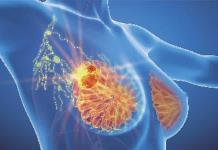 Influencia de la gen&eacute;tica en el desarrollo del c&aacute;ncer de mama