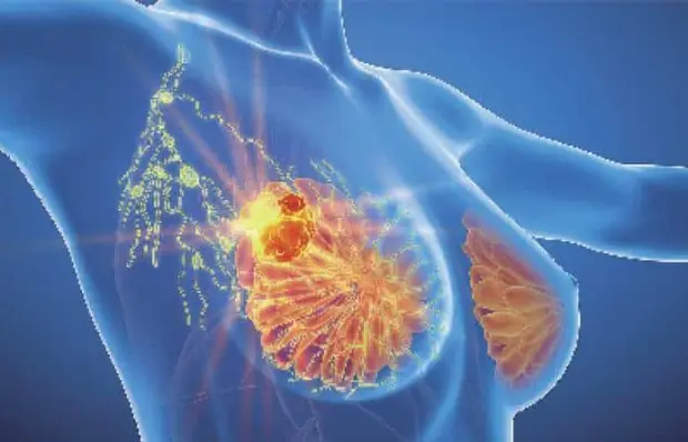 Cient&iacute;fico presenta que identificar c&aacute;ncer de mama a trav&eacute;s de IA