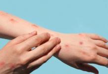 Detectan en Suecia el primer caso de mpox o viruela del mono fuera de África