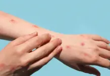 Ayuda internacional para combatir la epidemia de mpox en la RDC