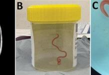 Extraen del cerebro de una australiana una lombriz intestinal viva de 8 centímetros