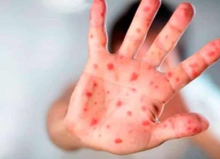 Alerta epidemiológica por casos de sarampión en México