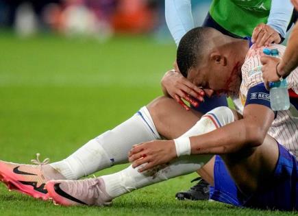 Mbappé sale con fractura de nariz; será operado Mbappé sale con fractura de nariz; será operado