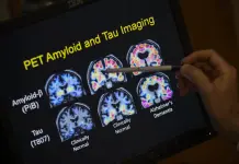 Avances en diagn&oacute;stico del Alzheimer mediante an&aacute;lisis de sangre