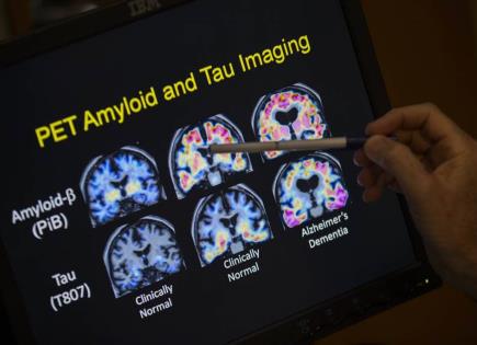 Avances en diagnóstico del Alzheimer mediante análisis de sangre