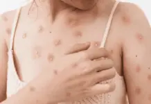 Medidas de Prevenci&oacute;n contra la Viruela del Mono