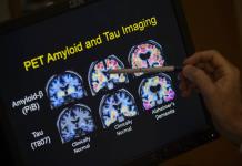 Autorización de fármaco para tratar el Alzheimer en Reino Unido