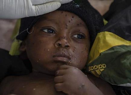 En Ruanda empiezan a vacunar contra el mpox