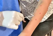 Caso de Mpox en Morelos: Medidas de la Secretar&iacute;a de Salud