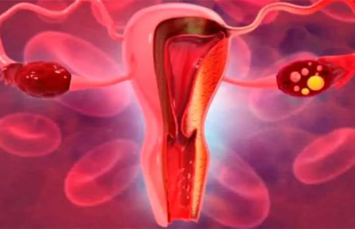 Síndrome de ovario poliquístico: Un desafío hormonal en mujeres