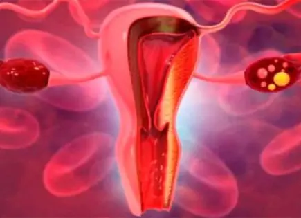 Síndrome de ovario poliquístico: Un desafío hormonal en mujeres