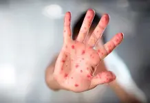 Unión Africana: Mpox es aún una emergencia de salud pública en África con 1,646 muertes