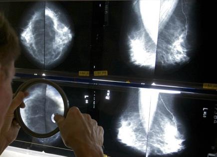 Avances médicos en cirugía y tratamiento de cáncer de mama