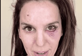 Accidente de tiro casi deja ciega a una actriz de Disney