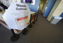 Brotes de sarampión en Estados Unidos y su impacto