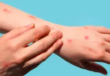 Segundo caso de sarampión en Guanajuato