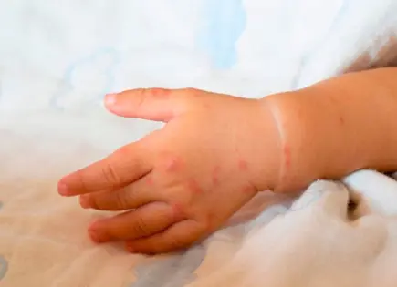 Muere niña rarámuri de sarampión