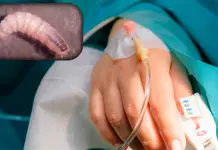 Suman 4 hospitalizados por gusano barrenador en México Suman 4 hospitalizados por gusano barrenador en México