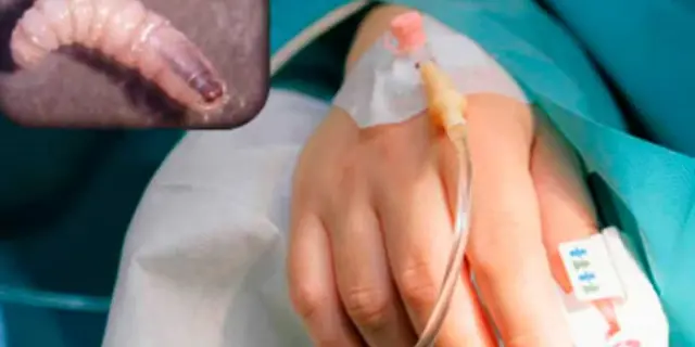 Reportan 30 Casos de Miasis Humana por Gusano Barrenador en México