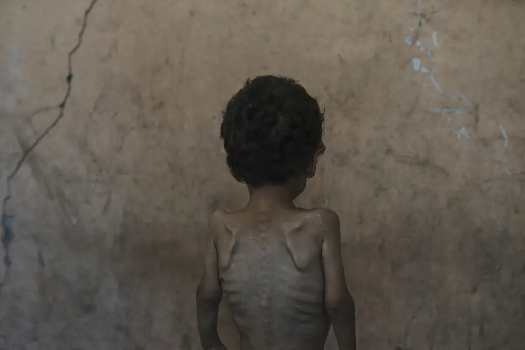 Aumento de desnutrición infantil en Gaza por crisis de hambre