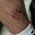 Muerde furioso can a varias personas