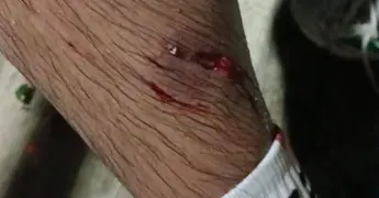 Muerde furioso can a varias personas