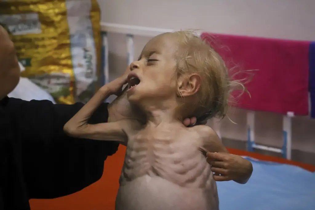 Desnutrición infantil en Gaza: Un drama que impacta a los más vulnerables