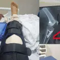 Sufre fracturas tras embestida de borrego en el Tangamanga I