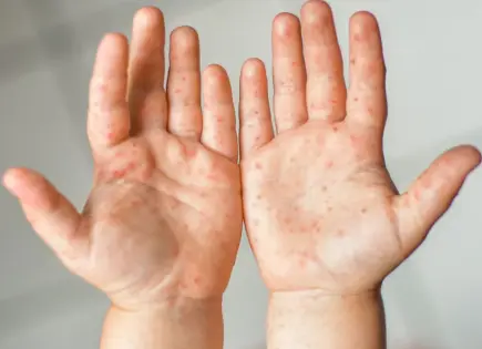 Alerta en Oaxaca por 753 Casos de Virus Coxsackie